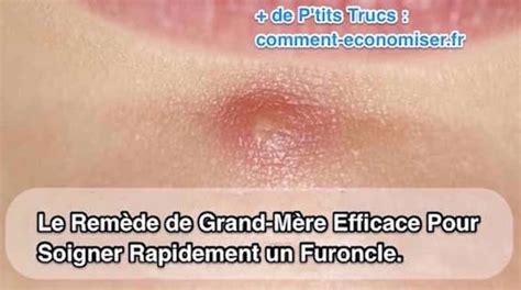 comment soigner un furoncle fessier|Furoncle fessier : causes, symptômes, diagnostic et traitements